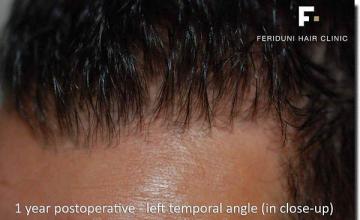 Hair restoration procedure results