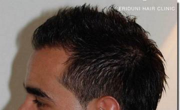 Hair restoration procedure results