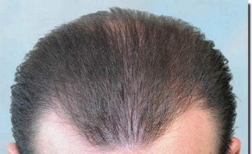 Hair restoration procedure results