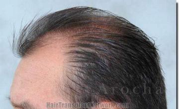 Hair restoration procedure results