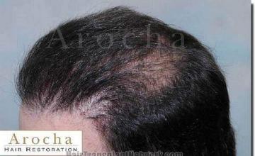 Hair restoration procedure results