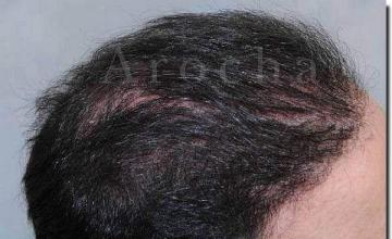 Hair restoration procedure results