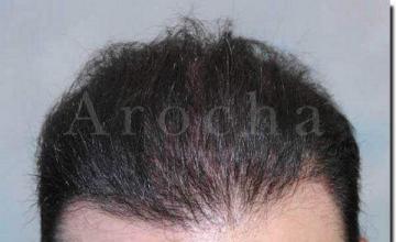 Hair restoration procedure results