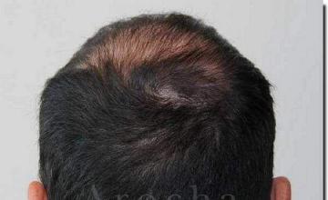 Hair restoration procedure results