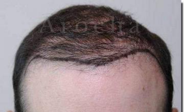 Hair restoration procedure results