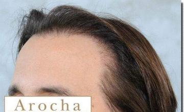 Hair restoration procedure results