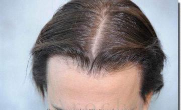 Hair restoration procedure results