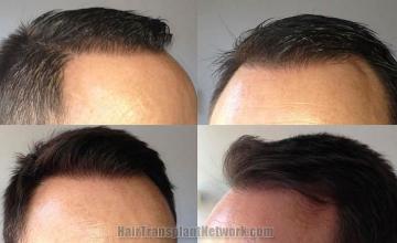 Hair transplantation surgery before and after images