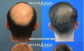 Surgical hair transplantation result photographs