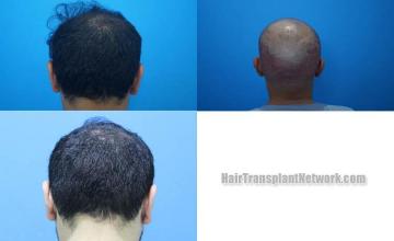 Hair replacement surgery before and after images