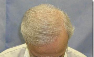 Hair restoration procedure results