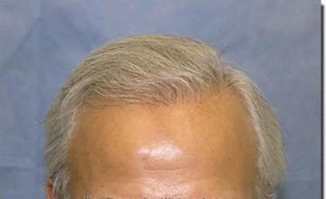 Hair restoration procedure results