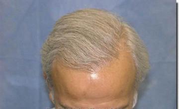 Hair restoration procedure results
