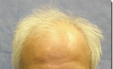 Hair restoration procedure results