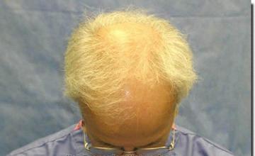 Hair restoration procedure results