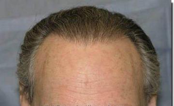 Hair restoration procedure results
