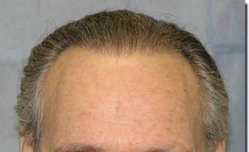 Hair restoration procedure results