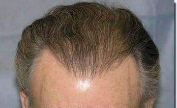 Hair restoration procedure results