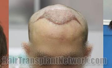 Hair restoration procedure before and after results