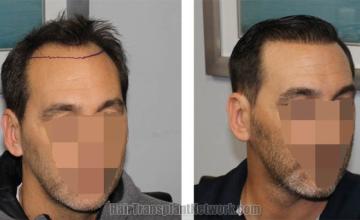 Hair transplantation procedure before and after results