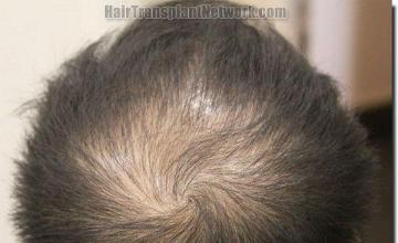 Hair restoration procedure results