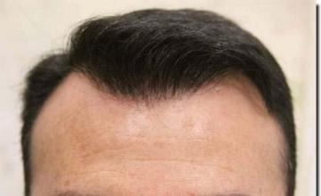 Hair restoration procedure results