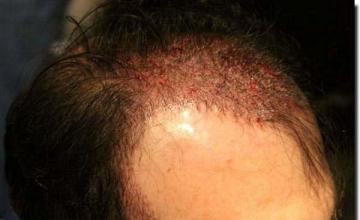 Hair restoration procedure results