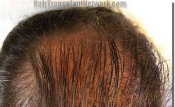 Hair restoration procedure results