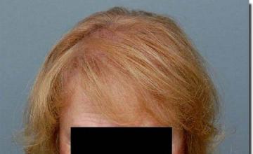 Hair restoration procedure results