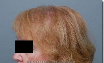 Hair restoration procedure results