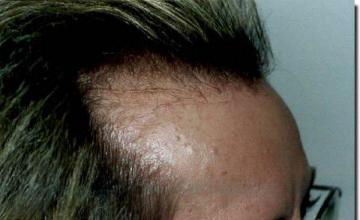 Hair restoration procedure results