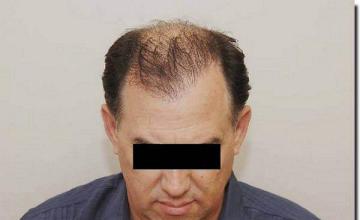 Hair restoration procedure results