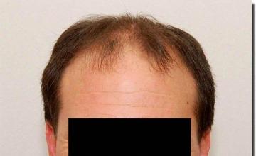 Hair restoration procedure results