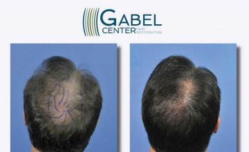 Surgical hair transplantation result photographs