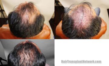 Hair transplantation procedure before and after photo results
