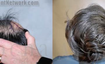 Surgical hair transplantation result photographs