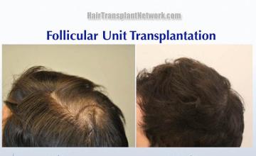 Hair transplantation surgery before and after pictures