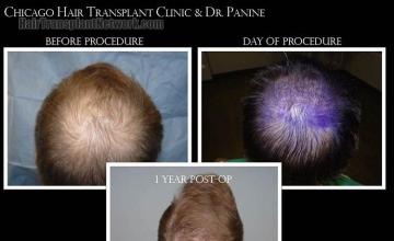 Hair restoration procedure before and after pictures