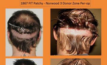 Hair transplant surgery before and after pictures