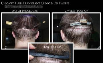 Hair restoration surgery after photos