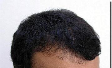 Hair restoration procedure results