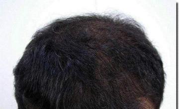 Hair restoration procedure results