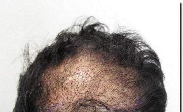 Hair restoration procedure results