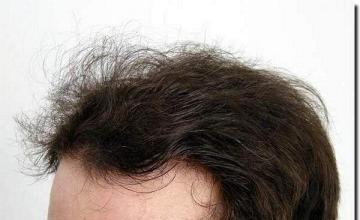 Hair restoration procedure results