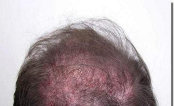 Hair restoration procedure results