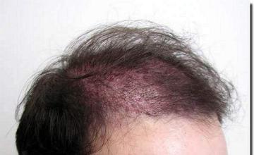 Hair restoration procedure results