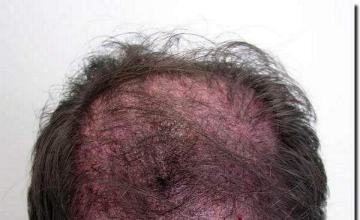 Hair restoration procedure results