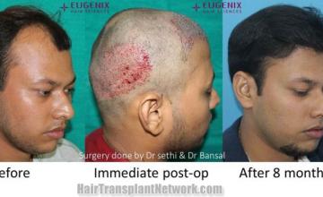 Hair transplantation procedure before and after results