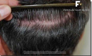 Hair restoration procedure results