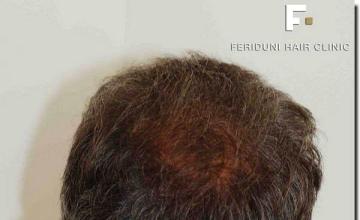 Hair restoration procedure results